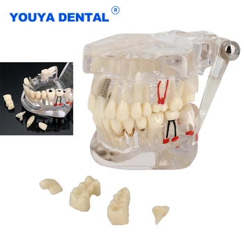 Zubný Implantát Model Ochorenia Zubov Nervová Opravy Patologické Typodont Obnova Mosta Výučby Štúdia Lekárske Vedy Ochorenia